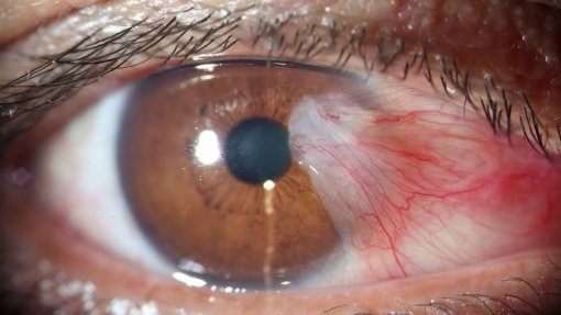 Cirurgia gratuita às cataratas beneficiou em dois anos 50 pessoas de Idanha-a-Nova