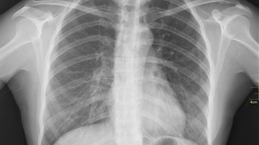 Pulmonale lança campanha sobre avanços no combate ao cancro do pulmão