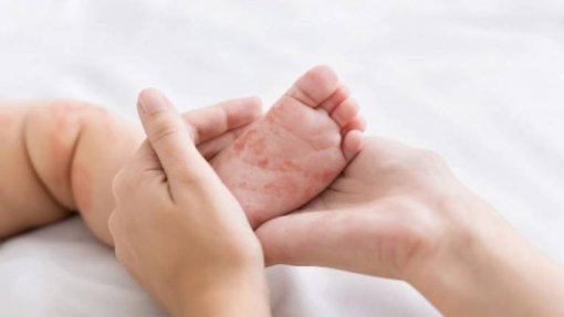 Sarampo matou mais de 140.000 pessoas no mundo em 2018