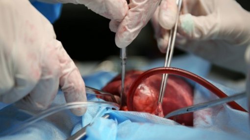 Covid.19: Sociedade Portuguesa alerta para nível de assistência a doentes transplantados