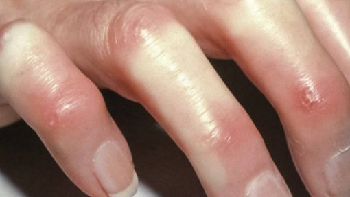 Associação pede a doentes com esclerodermia para perderem o medo e retomarem consultas