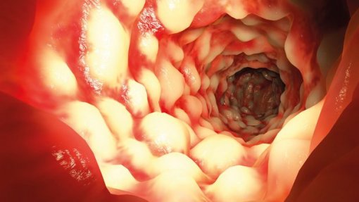 PEV questiona Governo sobre falta de medicamento para doentes com Doença de Crohn