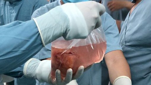 Portugal realizou em março o primeiro transplante renal cruzado internacional