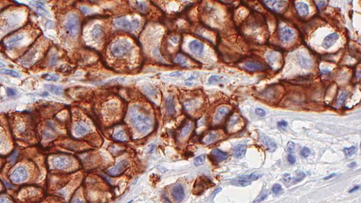Tumor diminui quando combinada radioterapia e nanopartículas de origem animal