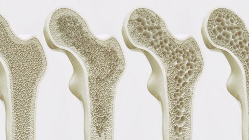 Profissionais de saúde e doentes com osteoporose pedem que não se descure a prevenção