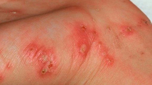 Estudo alerta para prevalência de sarna e impetigo nas crianças timorenses, das mais altas do mundo