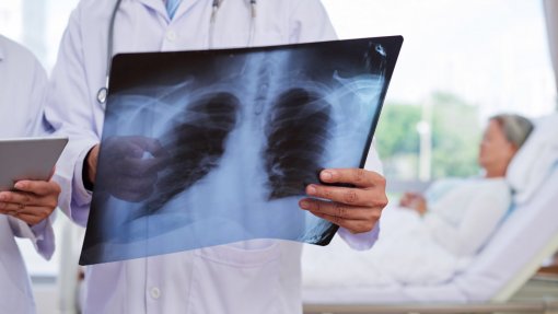 Covid-19: Pneumologistas pedem a doentes com agravamento de DPOC para irem ao hospital