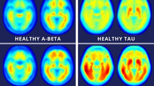 Estudo concluiu que placas que provocam Alzheimer podem não ter efeito destrutivo