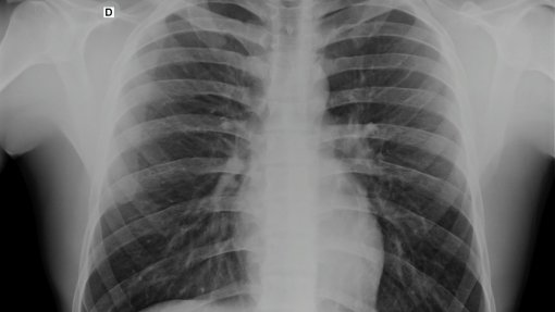 Espinho em projeto-piloto que realiza raio-x pulmonar no domicílio de utentes
