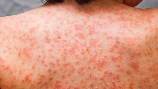 Covid-19: Estudo sugere que maioria dos sintomas de síndrome inflamatória desaparece ao fim de seis meses