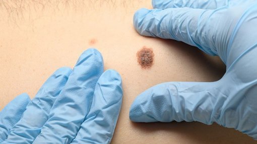 Associação Portuguesa de Cancro Cutâneo lança campanha na Feira de Agricultura