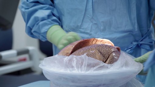Covid-19: Sequelas em pessoas que eram saudáveis levaram ao transplante pulmonar