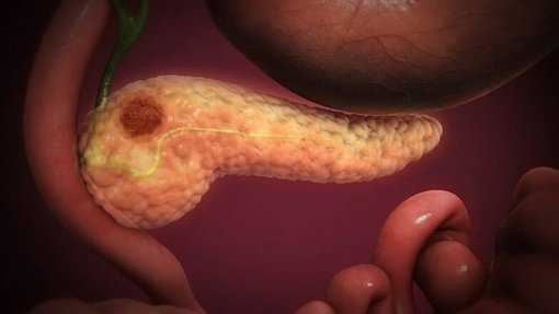 Investigadores desvendam método que impede progressão do cancro do pâncreas