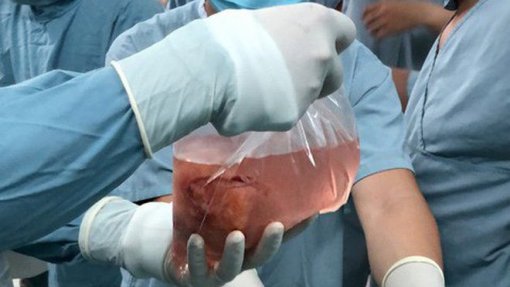 Cientistas anunciam sucesso de transplante de rins de porco para corpo humano