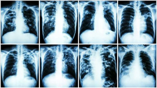 Sociedade de Pneumologia preocupada com aumento de mortes por tuberculose na Europa