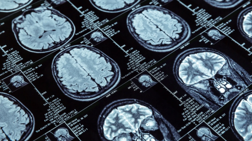 Ordem dos Médicos do Norte distingue estudo sobre tratamento de tumor cerebral maligno