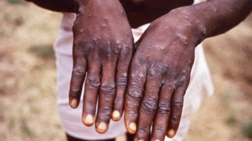 Monkeypox: Casos confirmados aumentam para 49 em Portugal