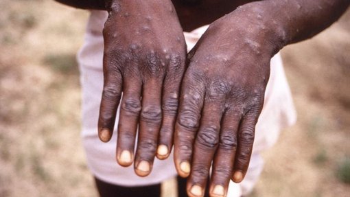 Monkeypox: Sete países africanos registaram 1.400 casos desde início do ano