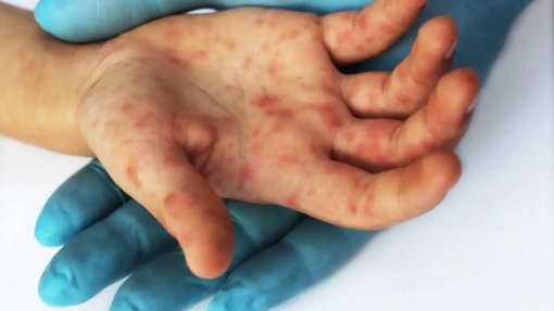 Monkeypox: Surto repentino em 30 países sugere que transmissão decorre há algum tempo - OMS