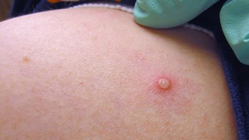 Monkeypox: Portugal com 276 casos confirmados – DGS