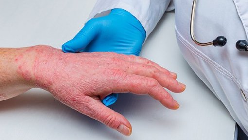 Monkeypox: Detetados mais 18 casos em Portugal, total sobe para 391