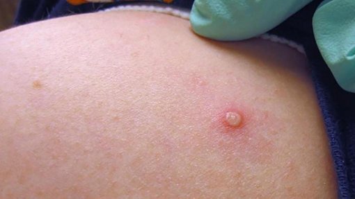 Monkeypox: Madeira regista segundo caso confirmado de infeção pelo vírus