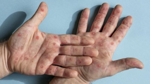 Monkeypox: Africa CDC alerta para aumento rápido das infeções devido à falta de vacinas