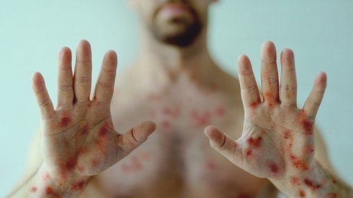 Monkeypox: Número de casos confirmados em Portugal sobe para os 898 - DGS