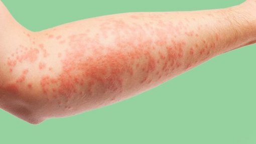 Doentes com dermatite atópica grave com tratamentos inovadores apenas no SNS