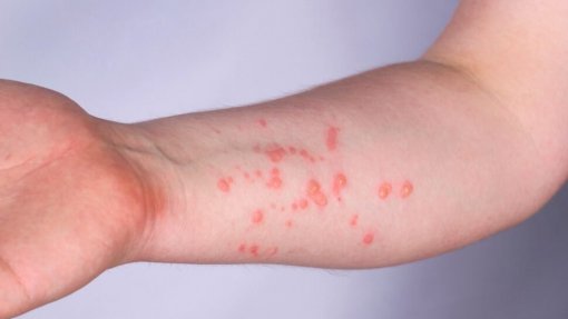Monkeypox: Número de casos confirmados em Portugal sobe para os 917 - DGS
