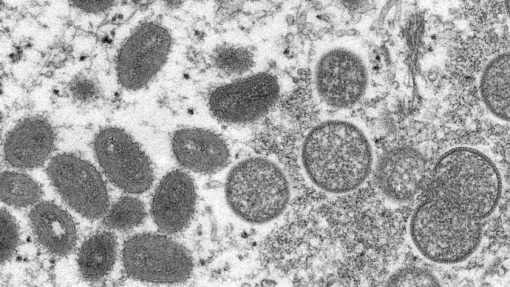 Monkeypox: Vírus é frequentemente transmitido antes dos primeiros sintomas – estudo