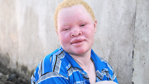 Associações denunciam aumento dos ataques contra albinos na Tanzânia