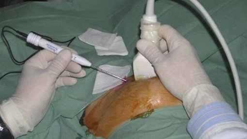 VILA REAL: Biópsia pulmonar transtorácica em regime ambulatório