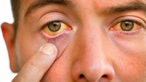 2021 com menos casos de hepatite A na Europa desde 2007 - relatório