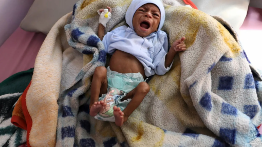 Iémen: Crise aumenta desnutrição infantil e causa mortes evitáveis em menores de 5 anos - MSF