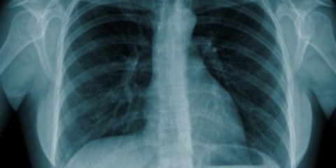 Casos de tuberculose diminuíram em 2021, mas diagnóstico ainda é tardio - relatório