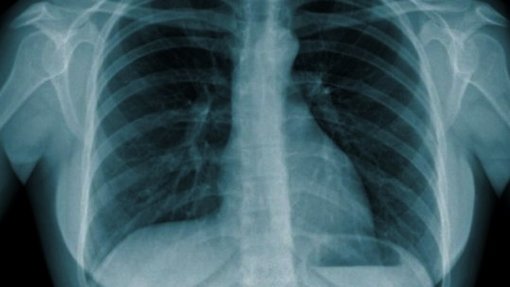 Casos de tuberculose diminuíram em 2021, mas diagnóstico ainda é tardio - relatório