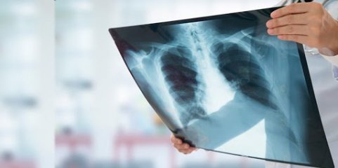 Norte e Lisboa e Vale do Tejo com as maiores incidências de tuberculose em 2021