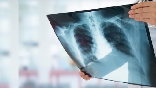 Norte e Lisboa e Vale do Tejo com as maiores incidências de tuberculose em 2021