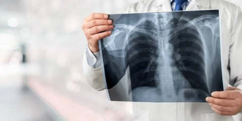 Sociedade Portuguesa Pneumologia alerta para estigma associado à tuberculose