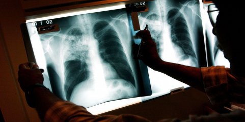Menos tuberculose em África mas metas para acabar com as mortes estão em risco - OMS
