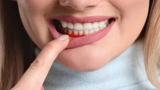Sociedade de Periodontologia pede que não se desvalorize sangramento das gengivas