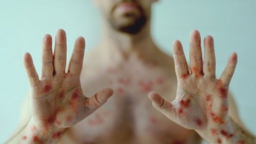 Mpox: Detetados dois novos caso em Portugal - DGS