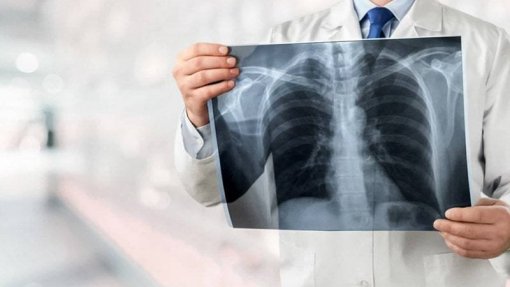 Pulmonale considera urgente rastreio nacional do cancro do pulmão
