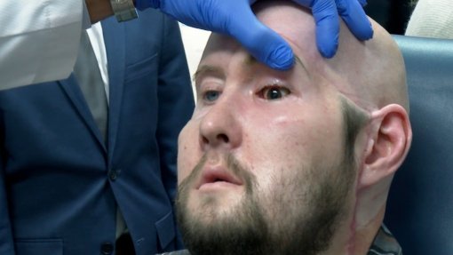 EUA: Hospital consegue transplantar um olho inteiro num paciente pela primeira vez