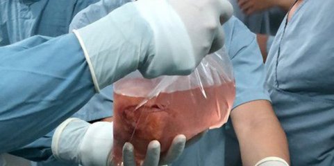 Portugal transplantou o maior número de órgãos de sempre em 2023 - Ministro da Saúde