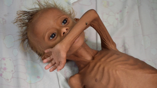 Iémen: UNICEF diz que meio milhão de crianças pode morrer por desnutrição aguda