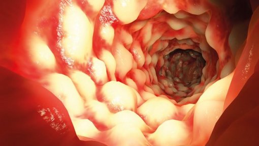 Reposição de medicação para doentes de Crohn até sábado - ULS Alto Minho