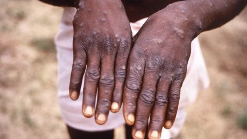 Mpox: Reino Unido ajuda RDCongo com 3,5 ME para combater epidemia