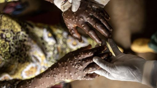 Mpox: Número de mortos ultrapassou os mil - CDC África